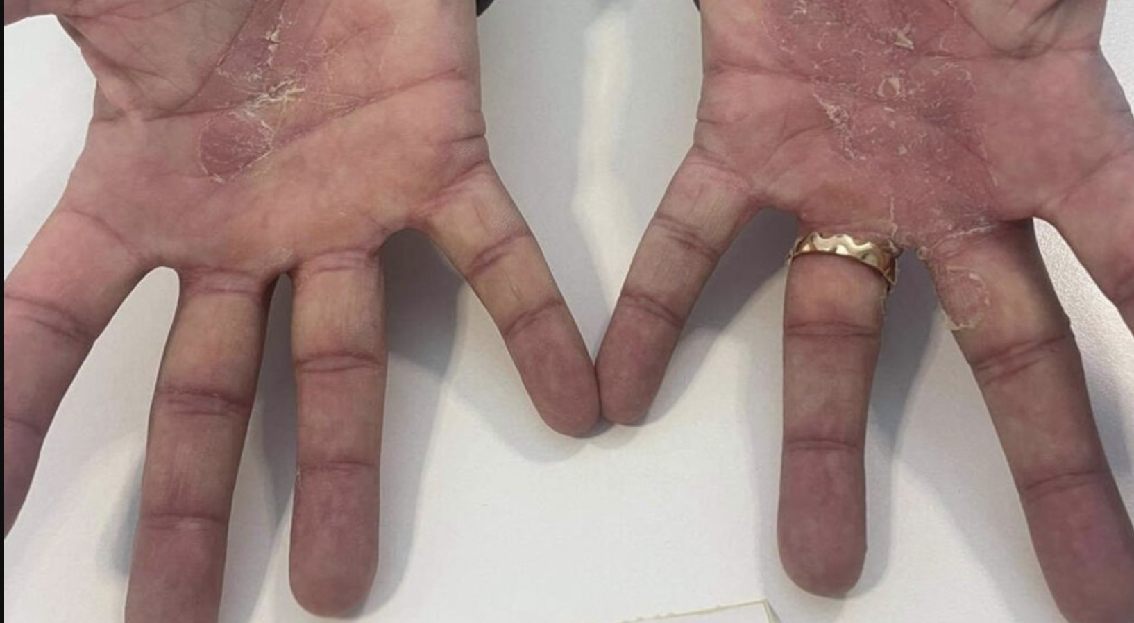 OPGELET: Deze 5 symptomen kunnen erop wijzen dat je reuma hebt