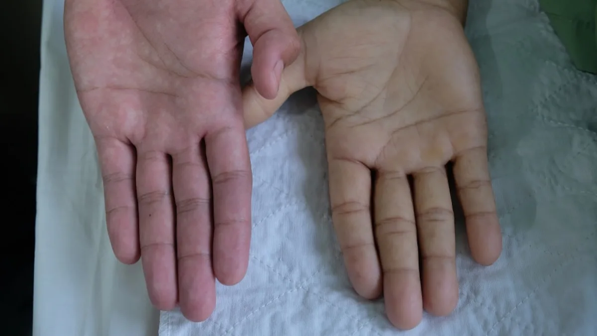 Negeer nooit deze 9 waarschuwingssignalen van bloedarmoede