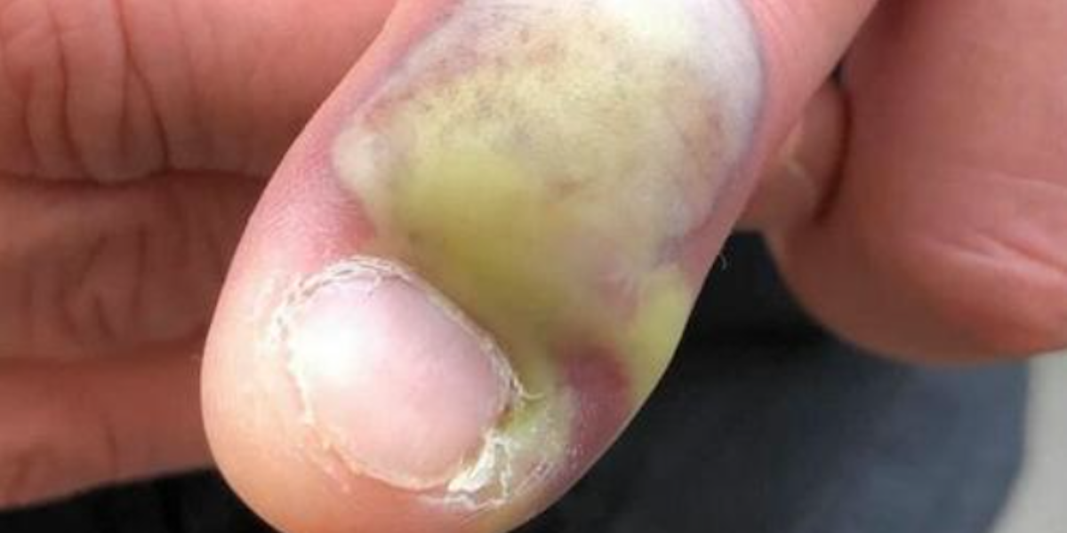 LET OP: Vrouw waarschuwt nagelbijters, nadat vriendin erdoor in ziekenhuis is beland