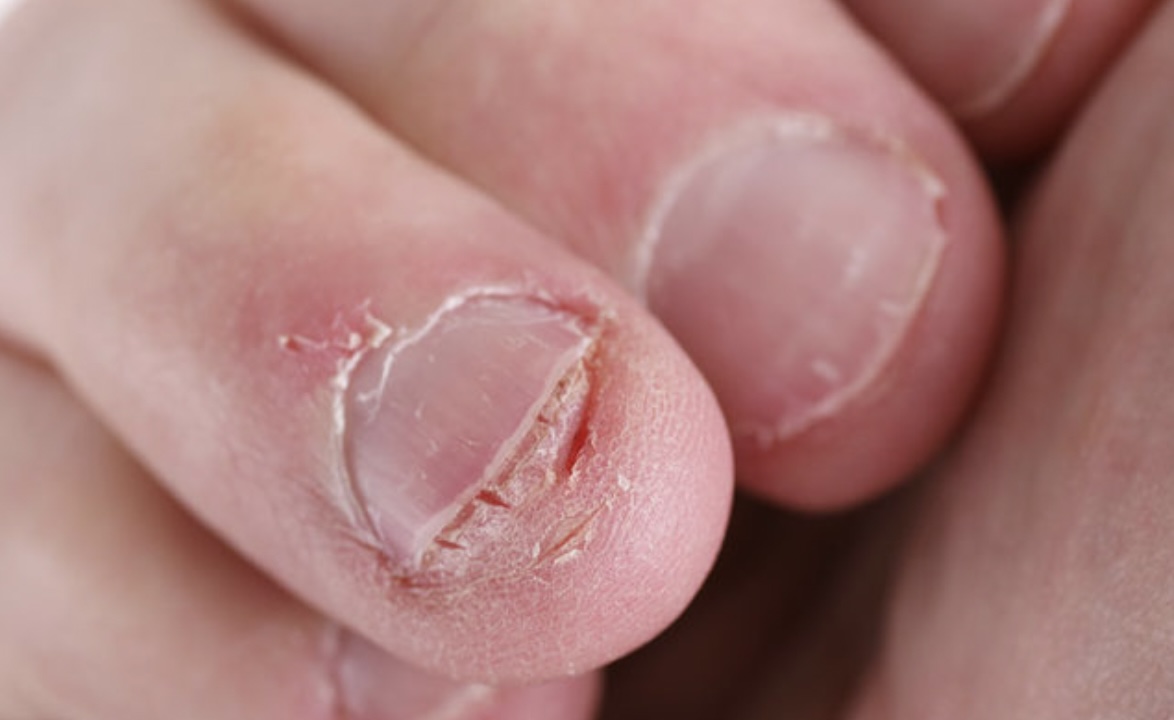 OPGEPAST: Bizarre video laat zien waarom je nooit meer op je nagels moet bijten