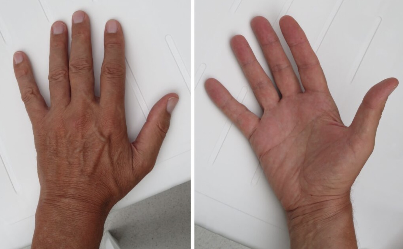 LET OP: Je kan de kans dat je kaal wordt berekenen door te kijken naar je vingers