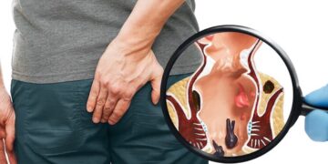 Dit zijn de wondermiddeltjes tegen aambeien!