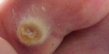 6 tips om likdoorns te verwijderen met huismiddeltjes die je al in huis hebt