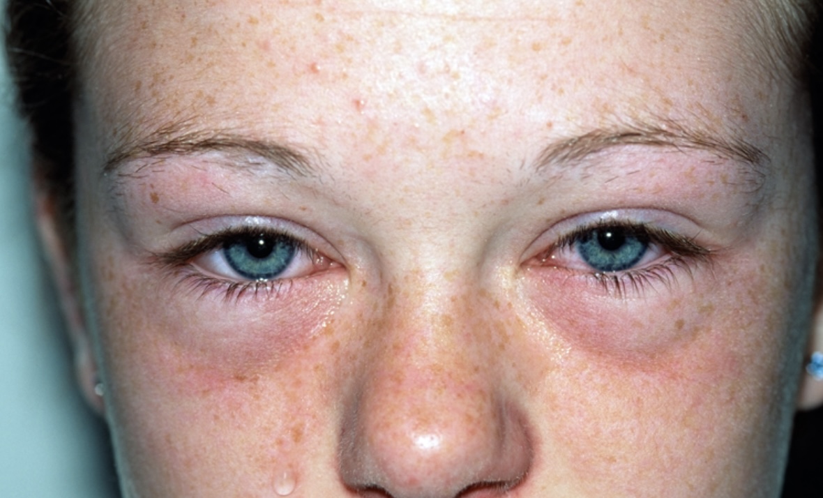 SUPERTIP: Deze simpele truc werkt als een trein tegen hooikoorts