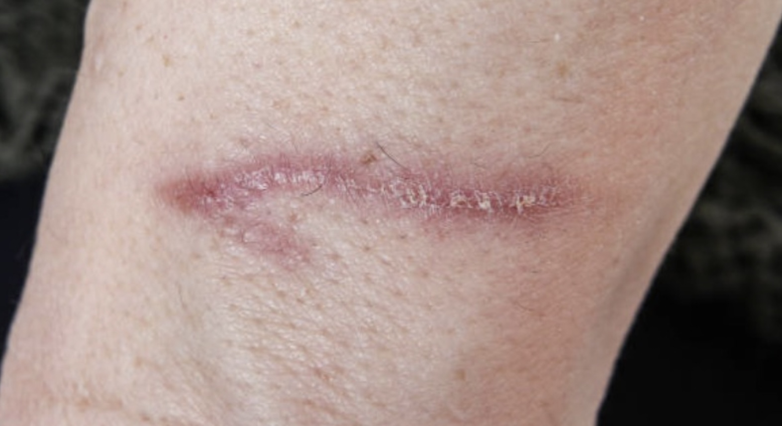 Nationale waarschuwing: “De vleesetende bacterie is in opmars!”