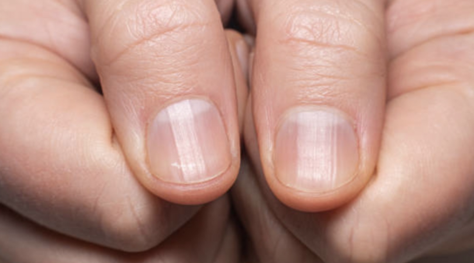 Waarschuwing: ‘Zien je nagels er zo uit? Bel dan direct de dokter!’