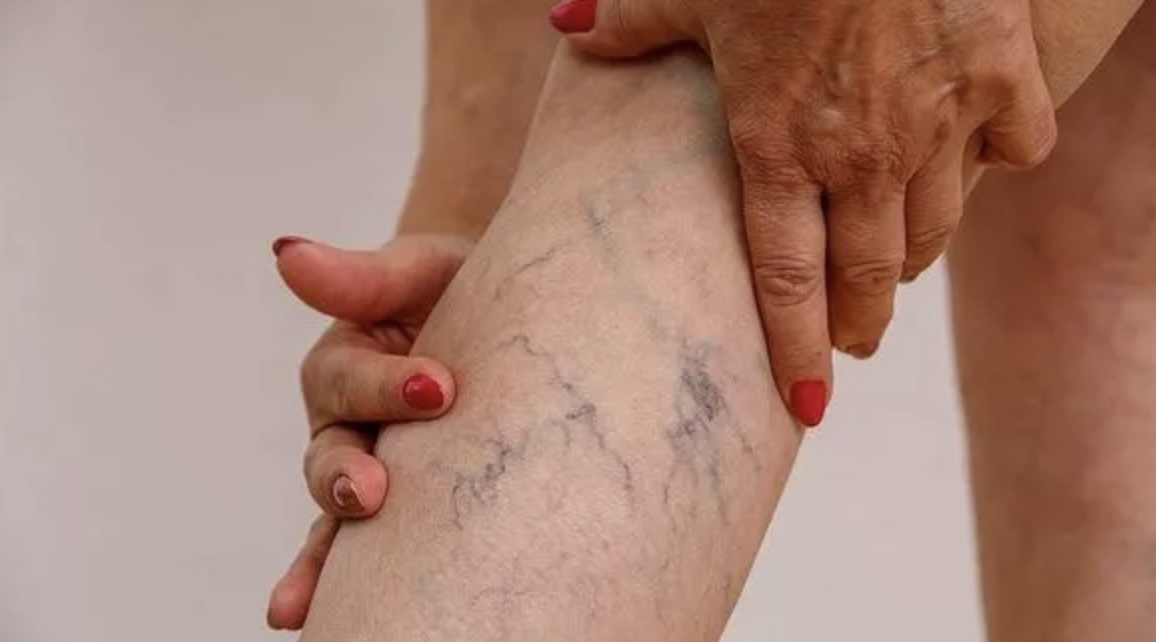 Arts waarschuwt: Dit zijn vijf ‘veelvoorkomende’ tekenen van bloedstolsels