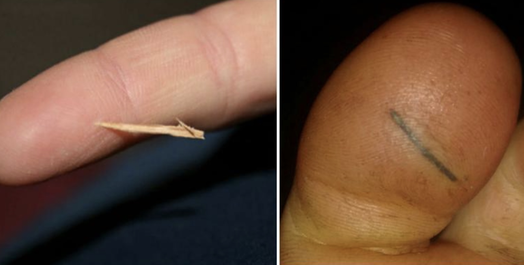 Moeder heeft geweldige manier om vervelende splinters te verwijderen; eenvoudig en snel!