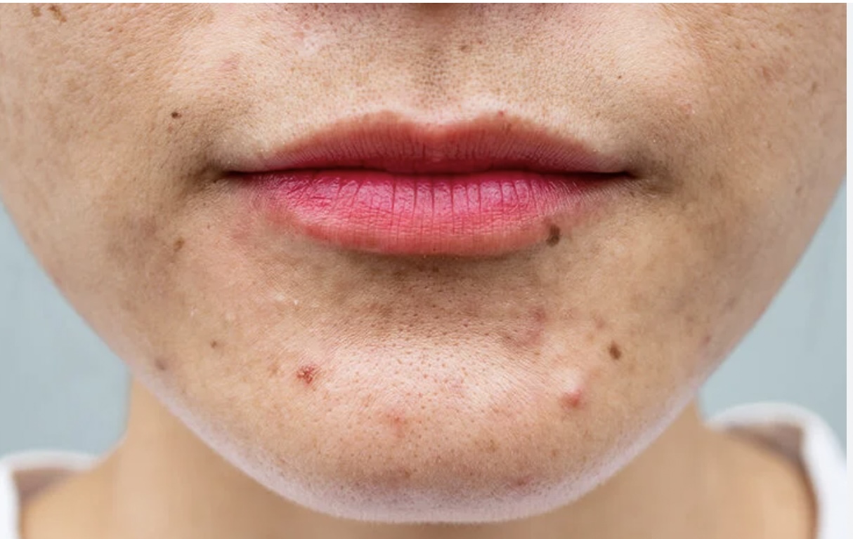 Dit is wat de locatie van je puistje kan zeggen over je gezondheid (is echt zo!)