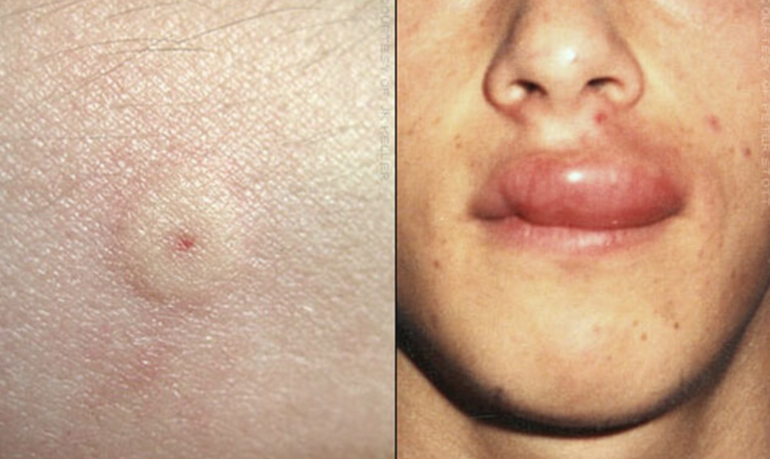 De waarheid over wespensteken: Waarom je NOOIT een wespensteek mag uitzuigen!