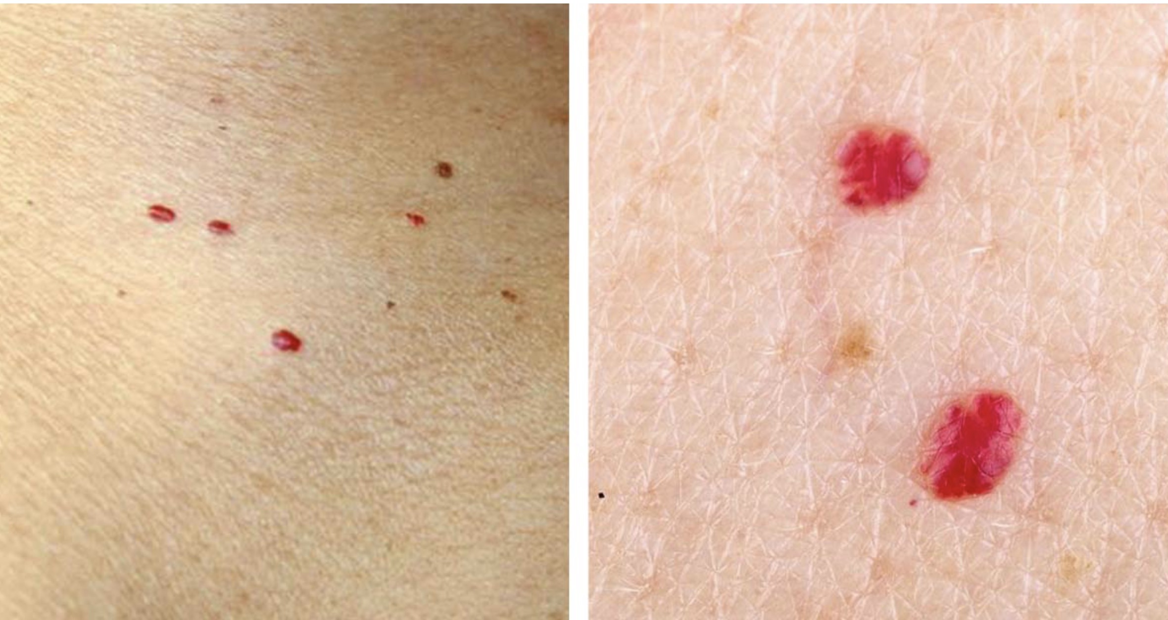 Let op! Kleine rode puntjes op de huid: dit betekenen ze