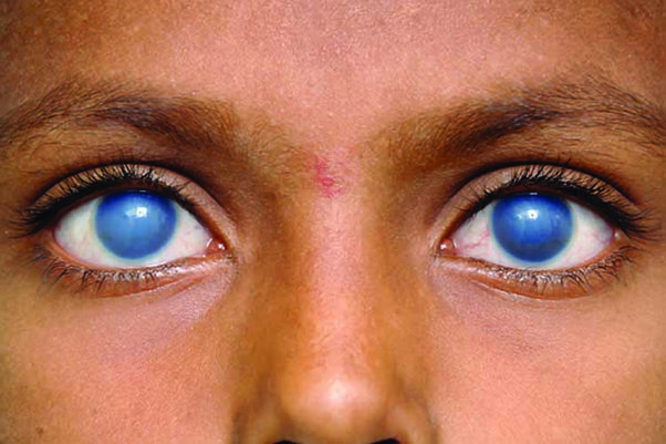 Op je stuitje vallen: Veroorzaakt dit nu wel of geen blindheid? (wij weten het!)