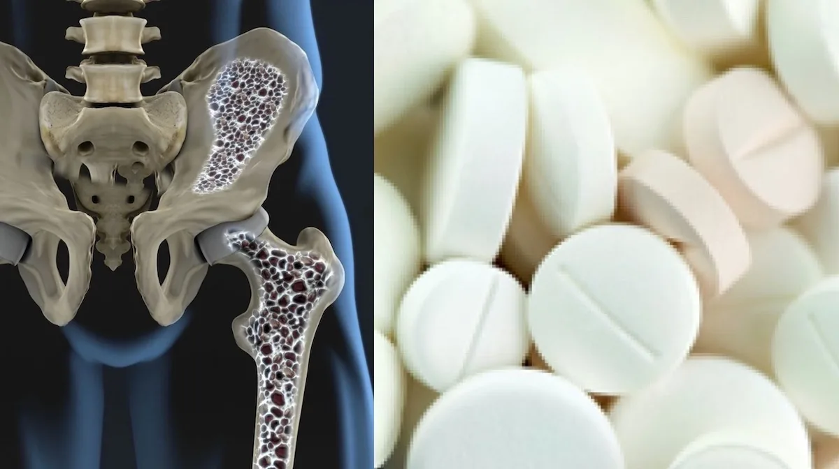 Van medicijnen tot ouderdom: dít zijn de meest voorkomende oorzaken van osteoporose!