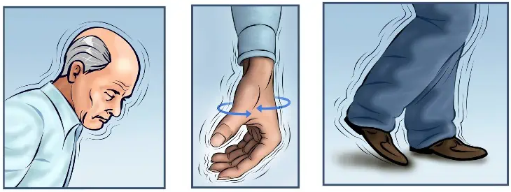 Niet trillen, maar dít zijn juist de eerste symptomen van Parkinson (zonder dat je het weet)