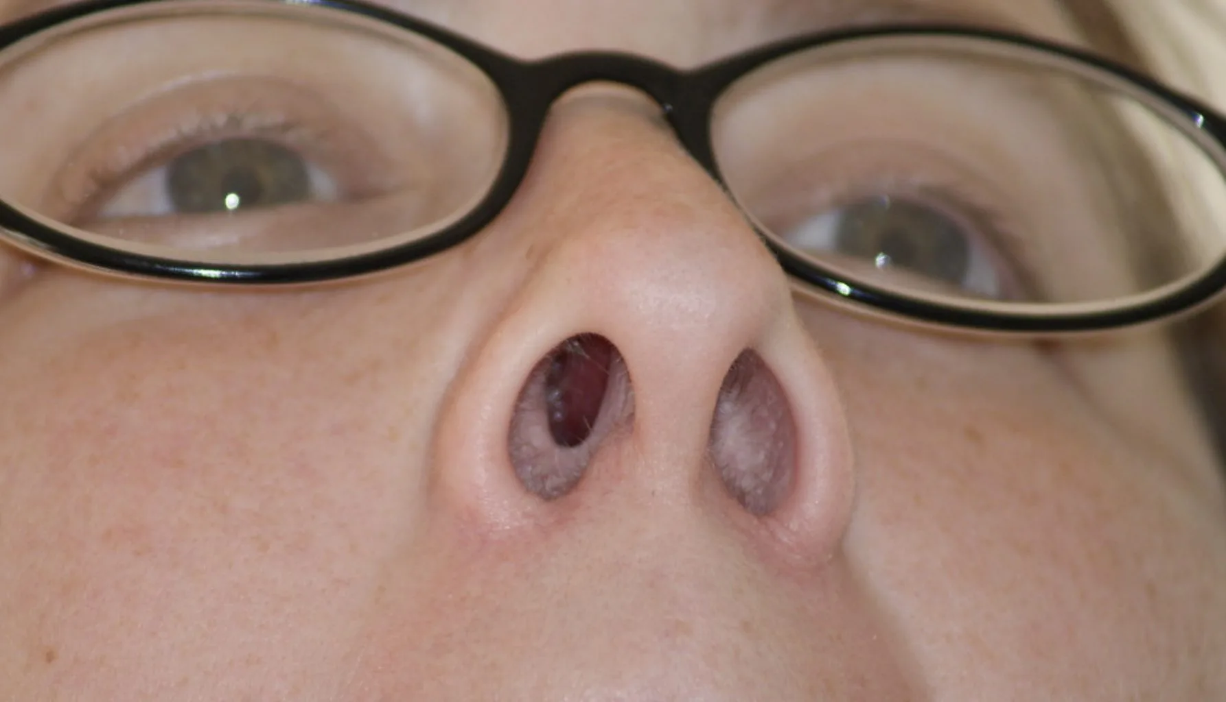 Artsen waarschuwen: Een verslaving aan neusspray heeft deze ernstige gevolgen