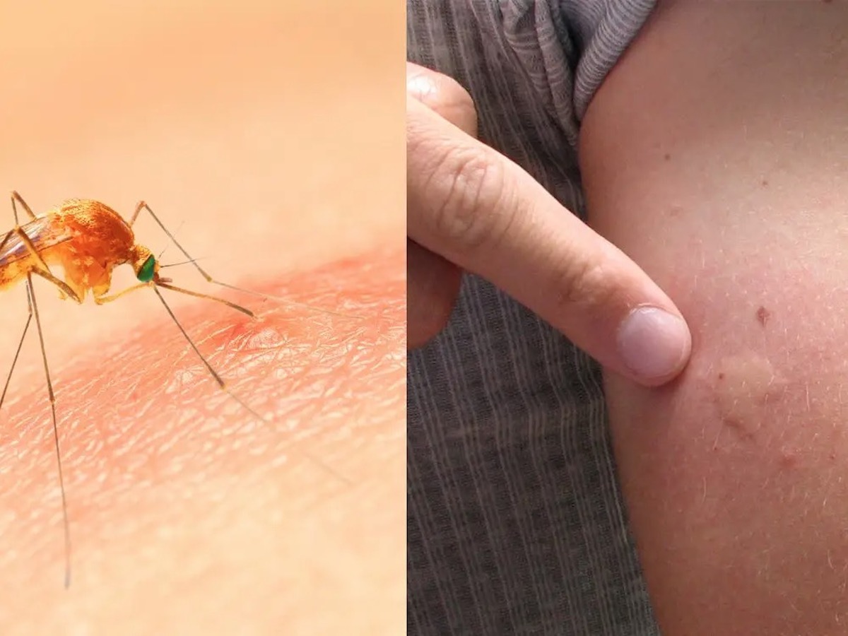 Dit is waarom jij altijd gestoken wordt door muggen!