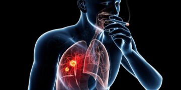 IKNL: Dit plan kan tienduizenden kankerdiagnoses voorkomen