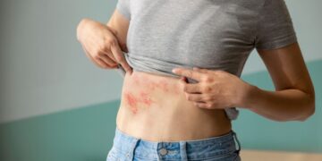 Dit zijn de heftige klachten die je kan overhouden aan gordelroos