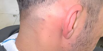 Kapper ontdekt gigantische ingegroeide haar die al drie jaar doorgroeit onder huid van klant!