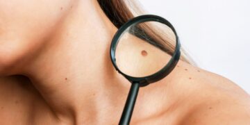 Op deze simpele natuurlijke manier kan je moedervlekken zelf verwijderen