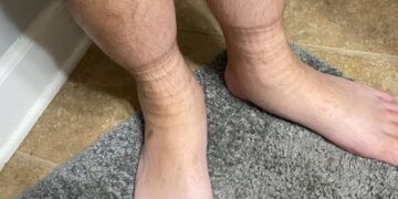 Strepen in je benen staan van je sokken in de avond? Dit is de oorzaak!