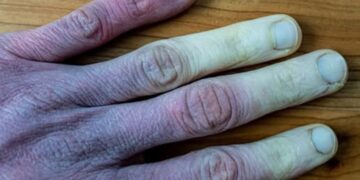 Wat te doen als je vingers wit worden in de winter?