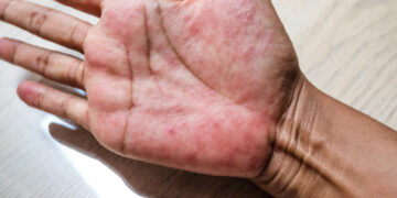 Dit is waarom je in de winter meer last kan krijgen van eczeem!