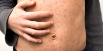 Mazelenuitbraak net voor carnaval: ‘Niet lekker? Blijf dan thuis!’