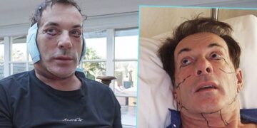 Gerard Joling ondergaat zware cosmetische ingreep (foto’s)