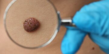 Verdachte moedervlek? Zo herken je een melanoom!