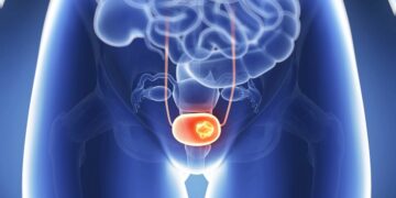 Onderzoek wijst uit: Steeds meer vrouwen met blaaskanker ‘Klachten worden vaak verward met een blaasontsteking’