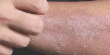 Last van een droge huid? Grote kans dat dit de veroorzaker is