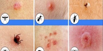 Zo herken je welke insect je gebeten heeft – en wat je eraan kunt doen