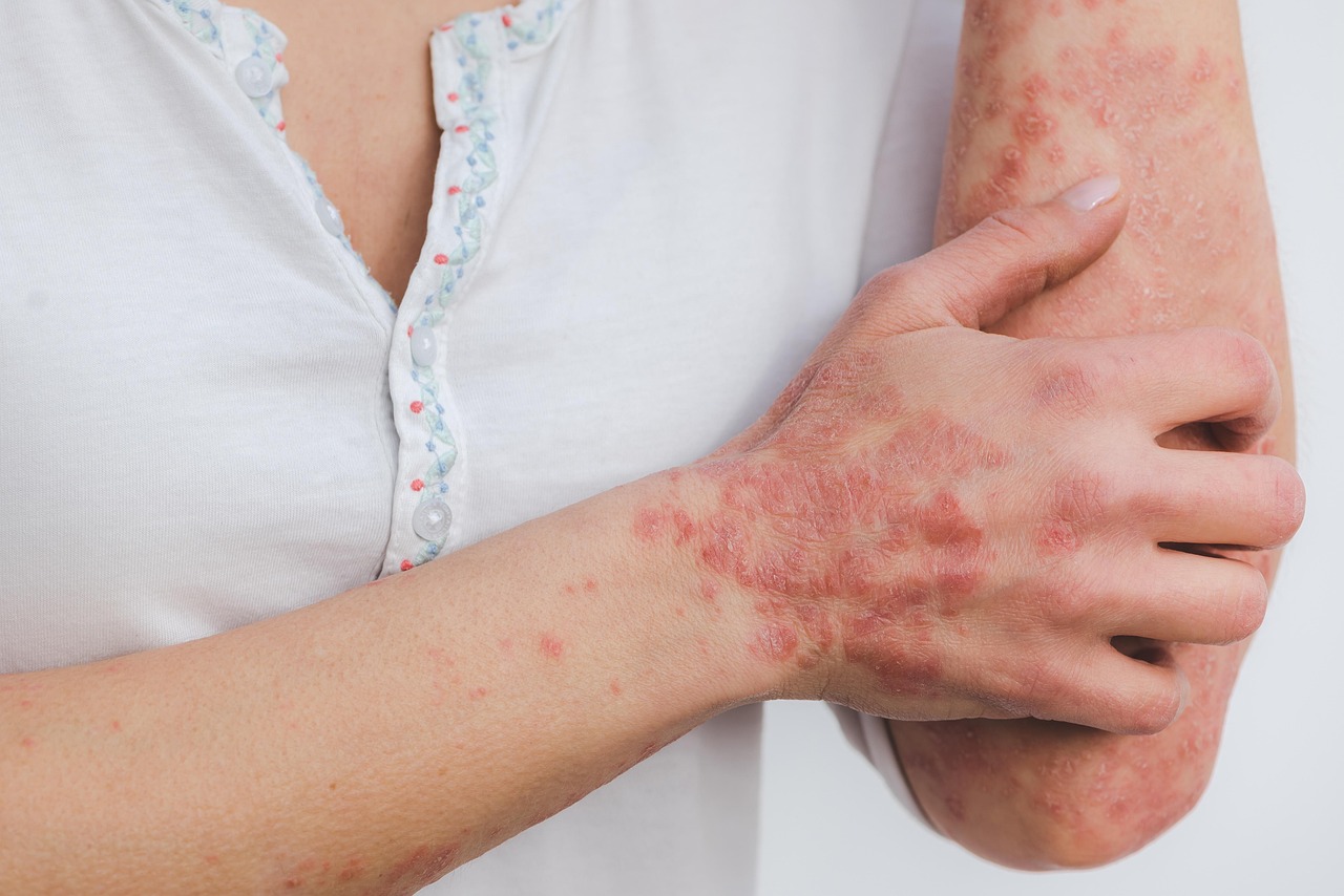 Psoriasis skin disease inflammation scaly skin disease red inflamed patient psoriasis psoriasis psoriasis psoriasis psoriasis inflammation skin disease skin disease