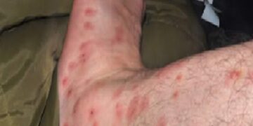 10 insectenbeten die je nooit mag negeren (en wanneer je naar de dokter moet)