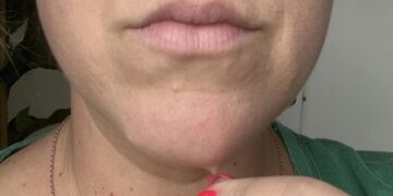 Aha: dit is waarom dat ene kinhaartje steeds terugkomt – en zo kom je er eindelijk van af!