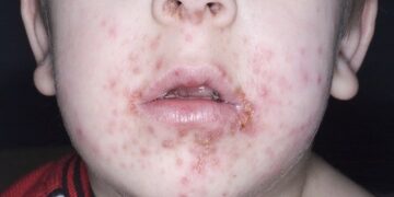 Dit is waarom krentenbaard op het moment zo veel voorkomt