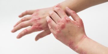 Deze waarschuwingssignalen van je huid mag je dus echt nooit negeren!