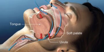 Dit is hoe je slaapapneu direct herkent – veel mensen hebben het zonder het te weten….