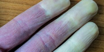 Artsen waarschuwen voor vingers die naar wit, blauw of rode kleur veranderen: dit moet je weten!