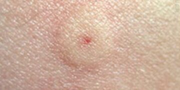 Gestoken door een wesp? Doe dit dan vooral NIET (lees wat je het beste kunt doen)