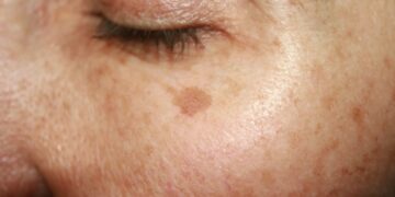 Dit is hoe je zonschade herkent op jouw huid (en bijna iedereen heeft het)