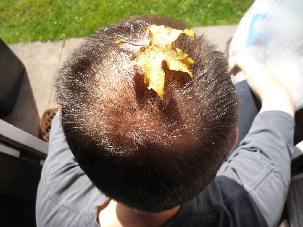 James bald spot 24 weeks - Info Vandaag