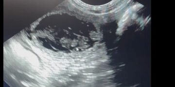 Verrassende gezinsuitbreiding voor Peter Gillis en vriendin