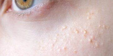 Wat betekenen die witte puntjes op je huid? Artsen slaan alarm
