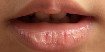 Altijd droge lippen? Dit zou er wel eens aan de hand kunnen zijn…
