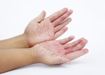 1 op de 2000 mensen is allergisch voor kou: dit zijn de symptomen