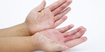 1 op de 2000 mensen is allergisch voor kou: dit zijn de symptomen