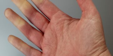 Slechte bloedsomloop herkennen? Dit zijn de symptomen én oplossingen om het snel te verbeteren