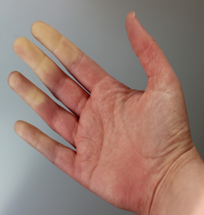 slechte-bloedsomloop-verbeteren - Info Vandaag